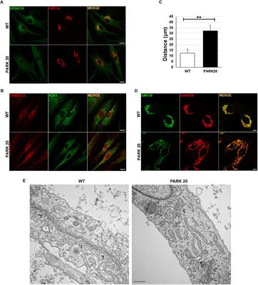 PERK-Mediated Unfolded Protein Response Activation and Oxidative Stress in PARK20 Fibroblasts